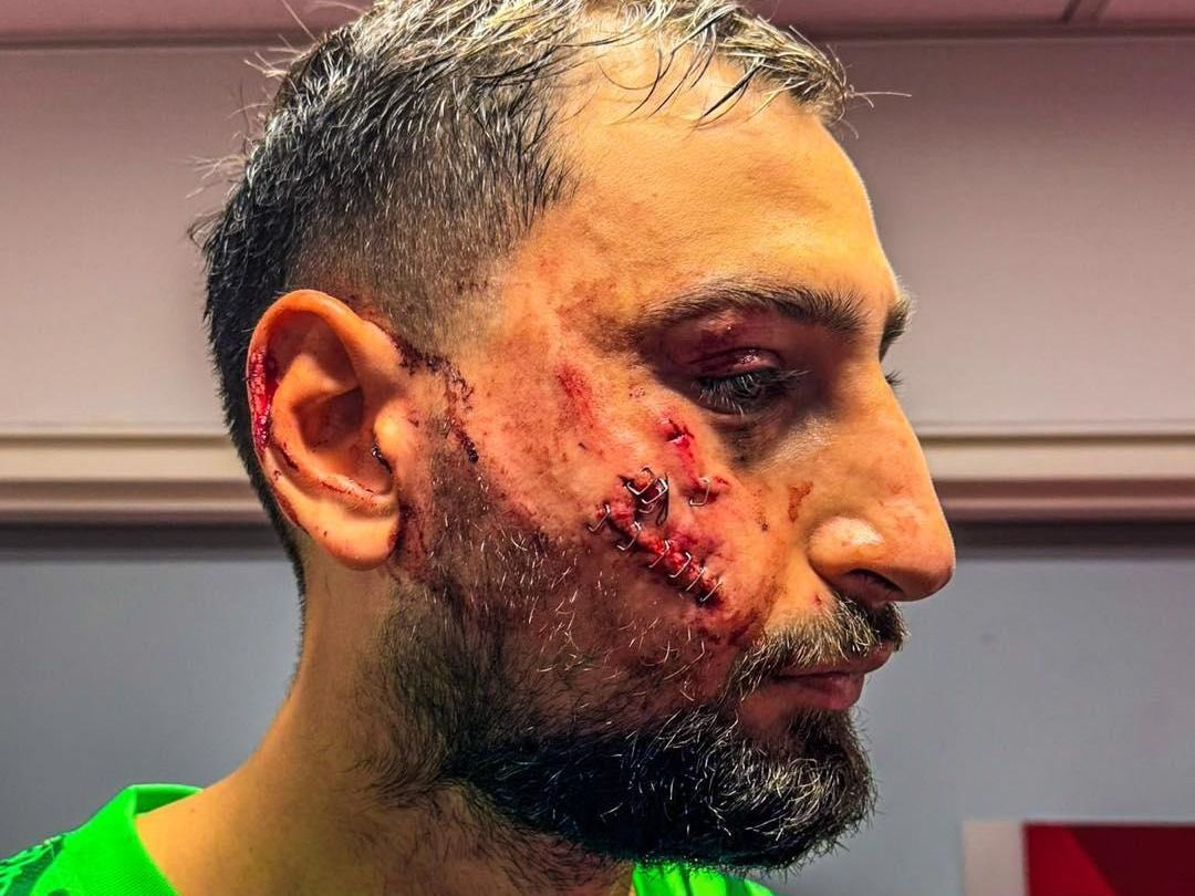 Gianluigi Donnarumma, PSG, sérülés