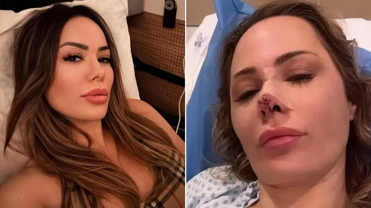 Horrorbaleset: leharapta egy kutya a népszerű influenszer orrát - fotó