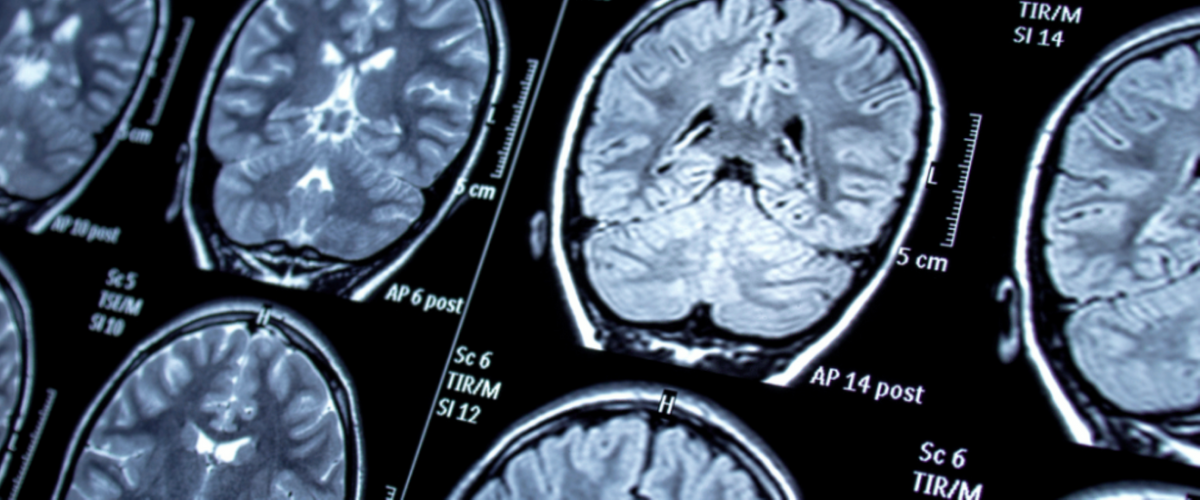 Ha valakiben felmerül az epilepszia gyanúja, mindenképpen forduljon orvoshoz!