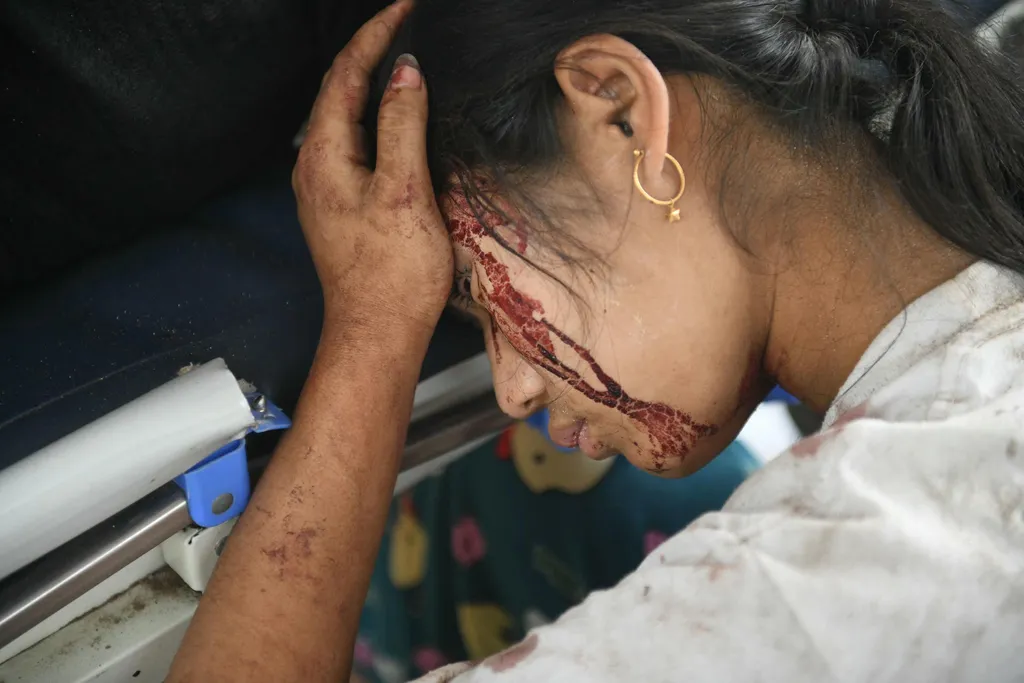 Blood is seen on the face of an earthquake survivors as she rests in a hospital in Naypyidaw on March 28, 2025, after an earthquake in central Myanmar. A powerful earthquake rocked central Myanmar on March 28, buckling roads in capital Naypyidaw, damaging