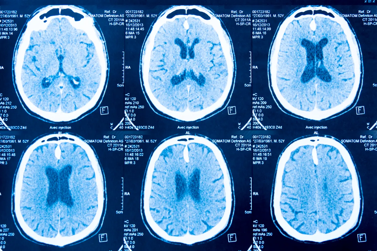 Brain scan 
Tomography of the brain obtained by scanner. (Photo by Yves Rousseau / BSIP via AFP)