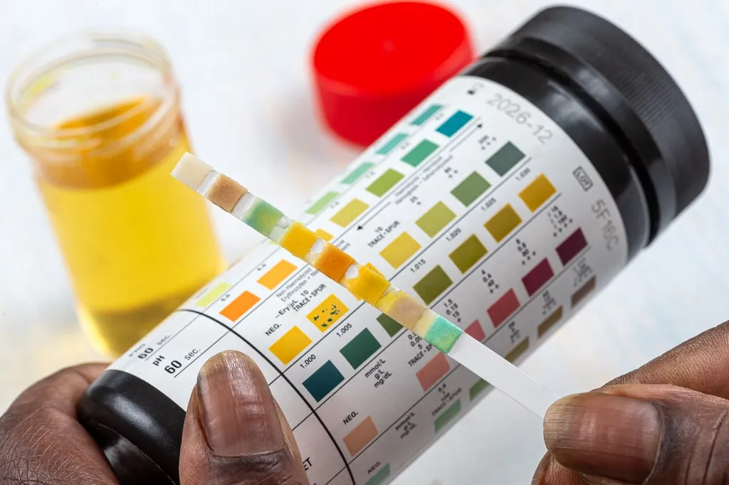 Self-test urine-strip 
Strip in front of the comparator table (Photo by CHASSENET / BSIP / BSIP via AFP)