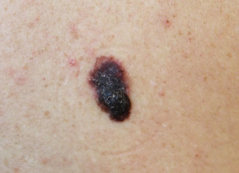A melanoma – a bőr pigmentsejtjeiből kiinduló rosszindulatú daganat – mára komoly népegészségügyi kihívássá vált. 