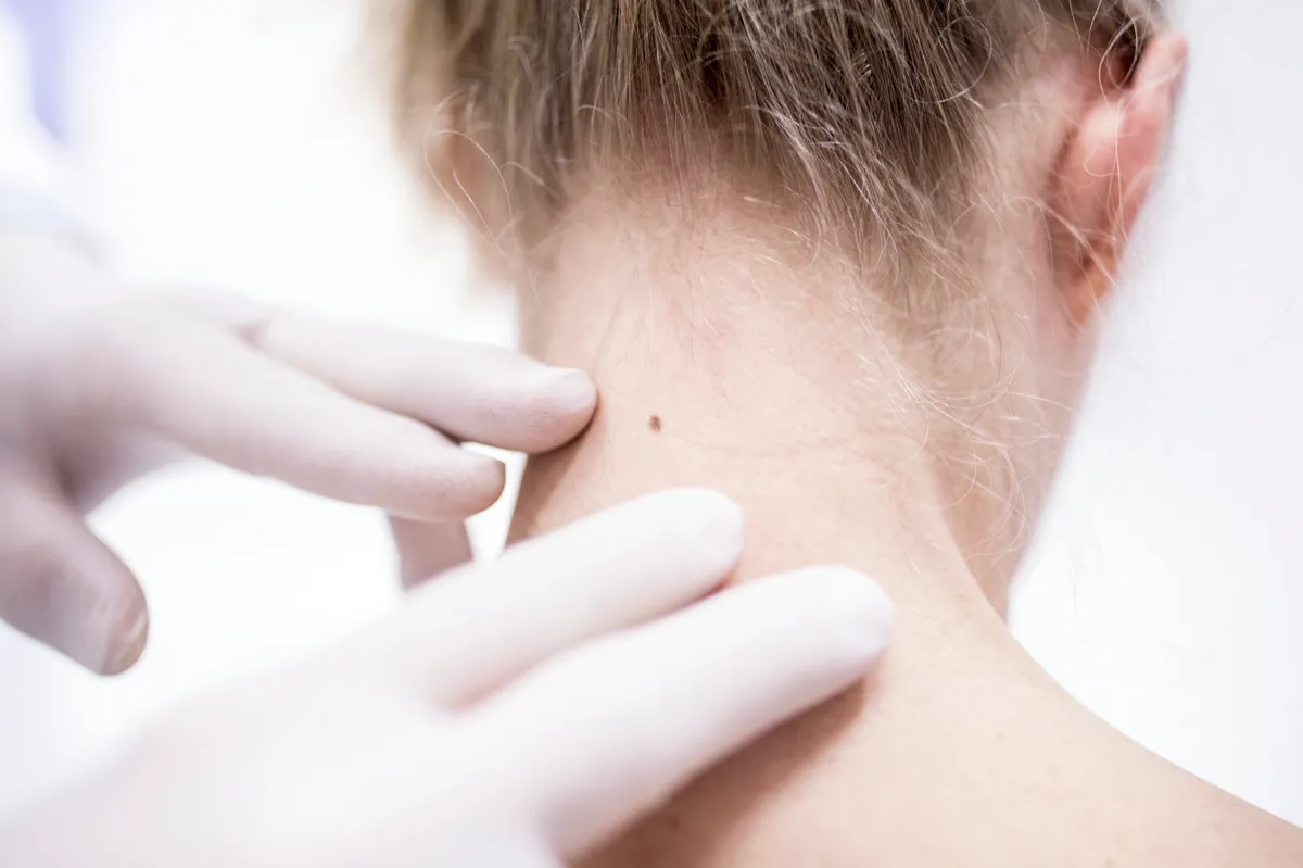 A fiatal rákos betegek száma ijesztően emelkedik. Az egyik leggyakoribb daganattípus náluk a melanoma.