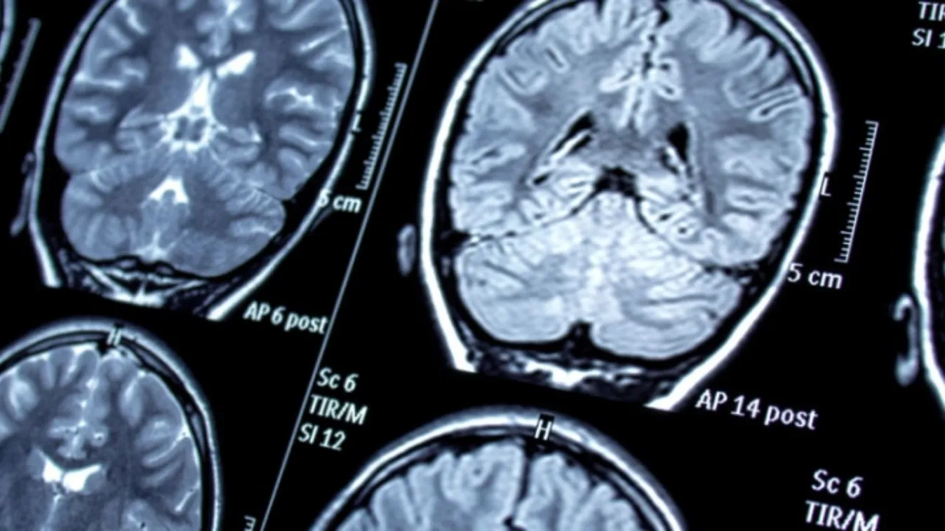 Hogyan hat az időjárás, az időjárási frontok az epilepsziára? Kép
