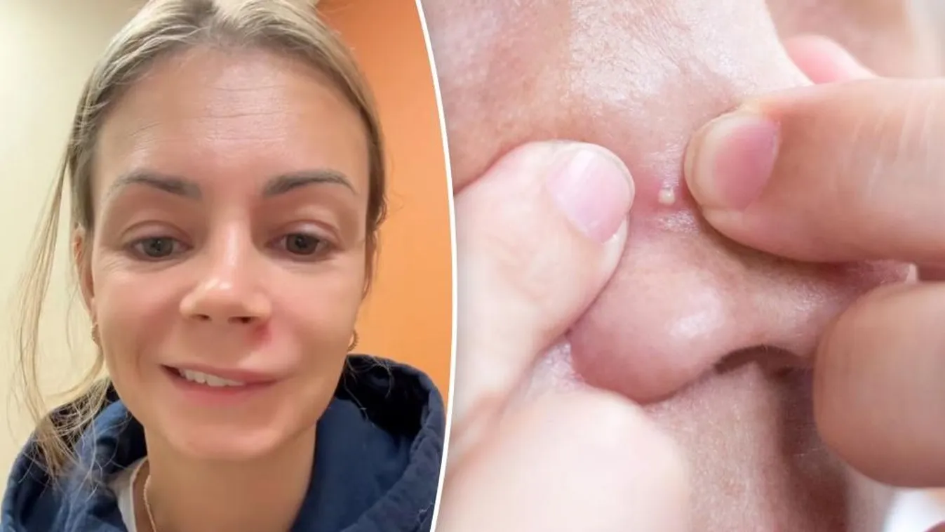 Csak egy pattanást nyomott ki, kis híján az életébe került Kép