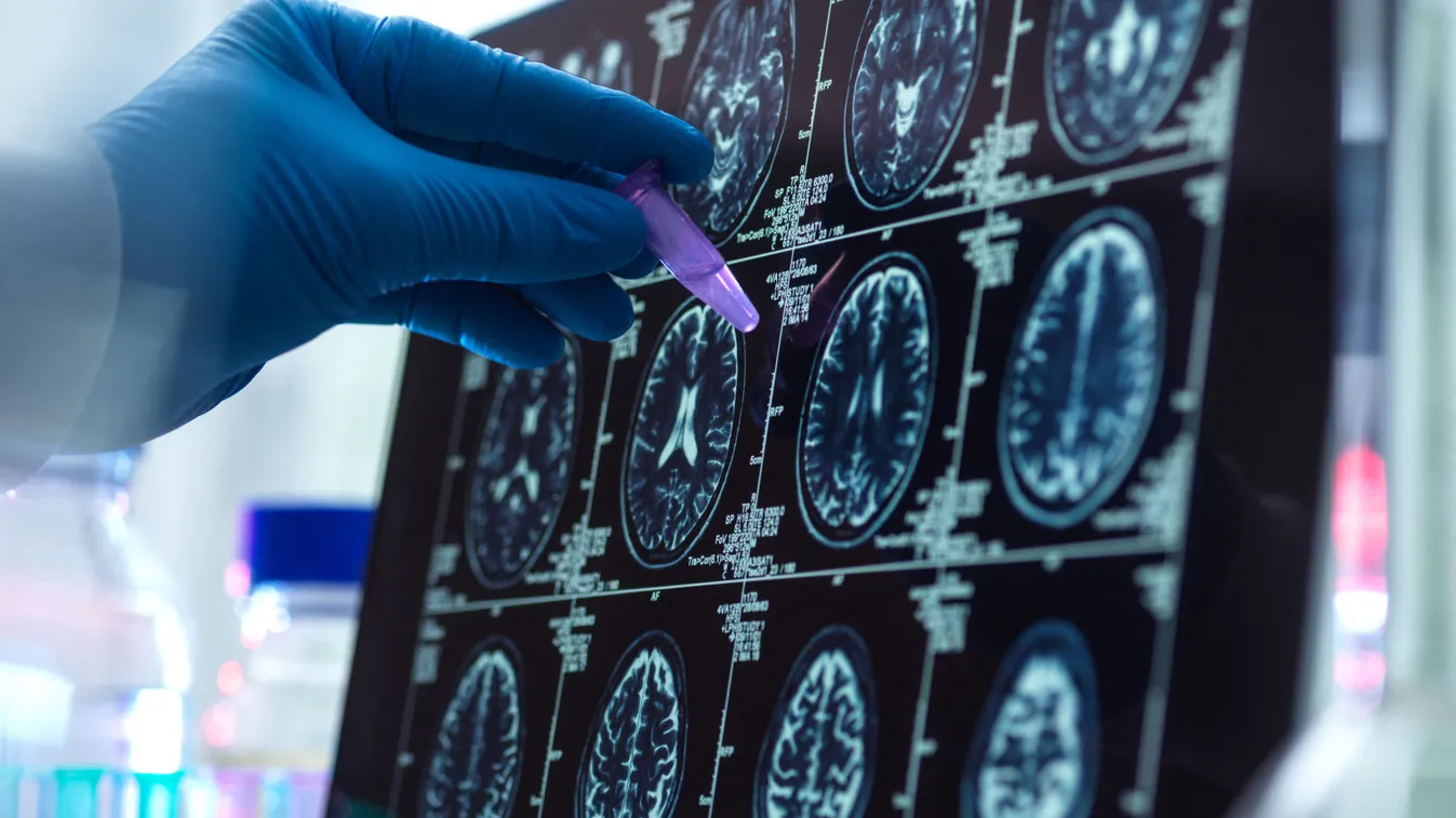Öregedés vagy Alzheimer-kór? - Így tudja megkülönböztetni! Kép