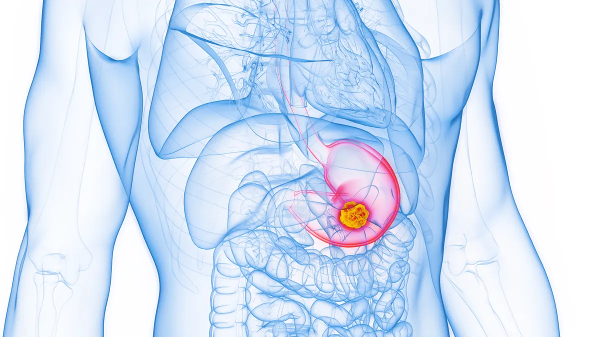 A gyomorrákot okozó baktérium világszerte terjed, és a becslések szerint közel 12 millió megbetegedést okozhat a jövőben.