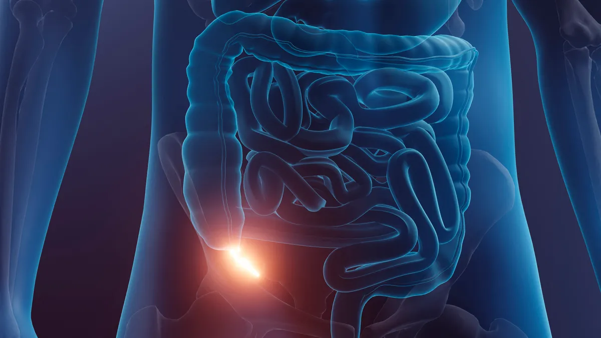 Egyre több fiatalt érint a vakbélrák.