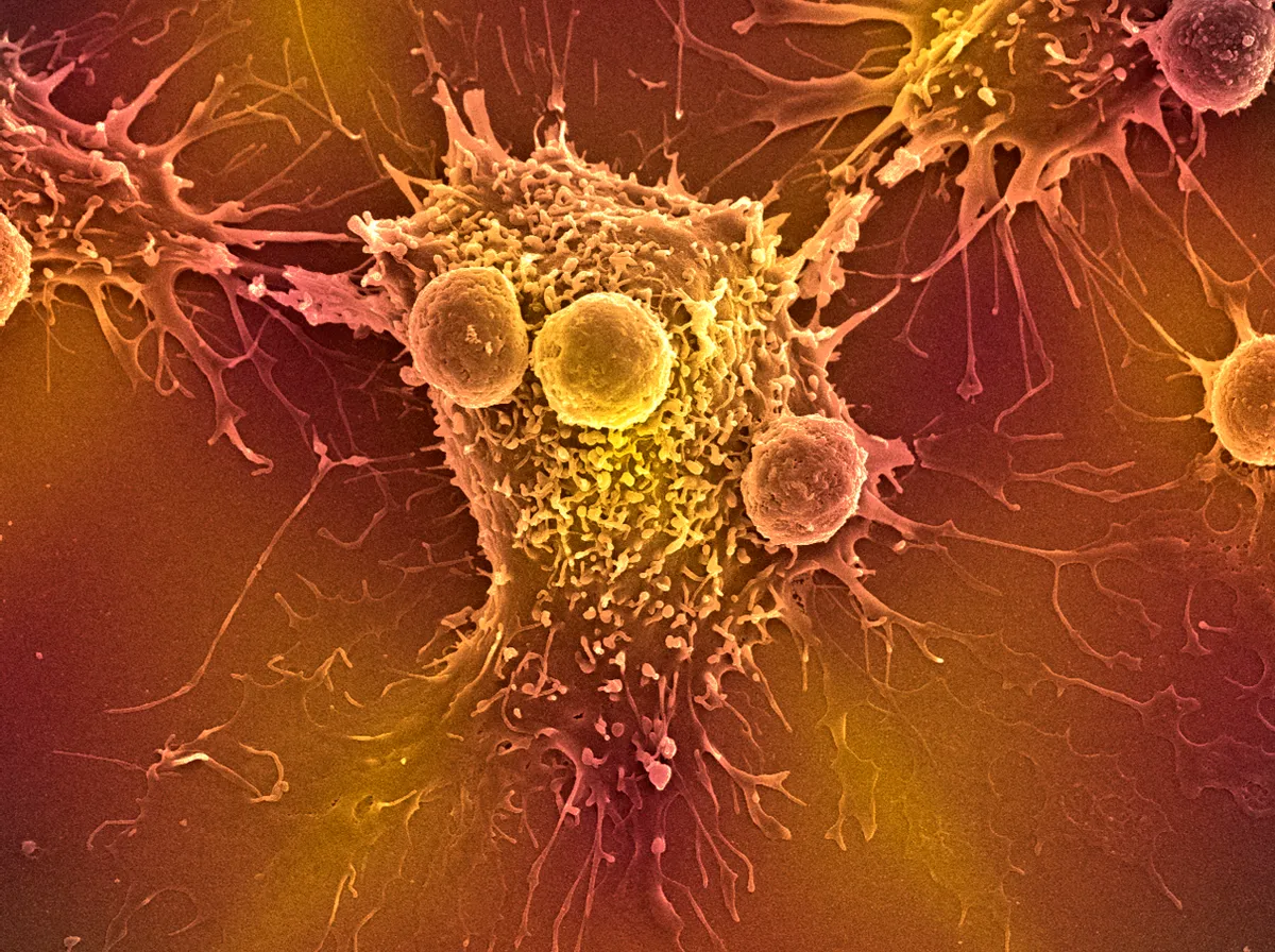 Ráksejt és T-sejtek képe. A Mary E. Brunkow és Fred Ramsdell amerikai, valamint Szakagucsi Simon japán tudós kapja az idei orvosi-élettani Nobel-díjat a perifériás immuntoleranciával kapcsolatos felfedezéseikért.