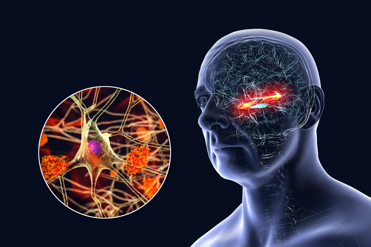 A modern orvostudomány egyik legnagyobb kihívása az Alzheimer-kór, egy olyan neurodegeneratív állapot, amely során az agy idegsejtjei folyamatosan pusztulnak, végül memóriavesztéshez és kognitív hanyatláshoz vezetnek.