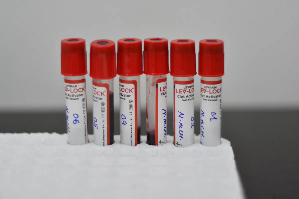 Nem jelent jót, ha a lipoprotein(a) szintje magas.