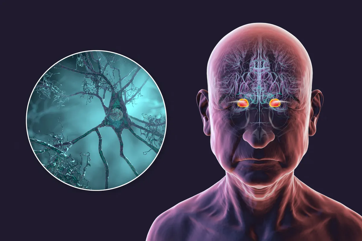 Összefüggést mutattak ki a vaszkuláris demencia és az agyban egyre nagyobb mennyiségben felgyülemlő mikroműanyagok között. 