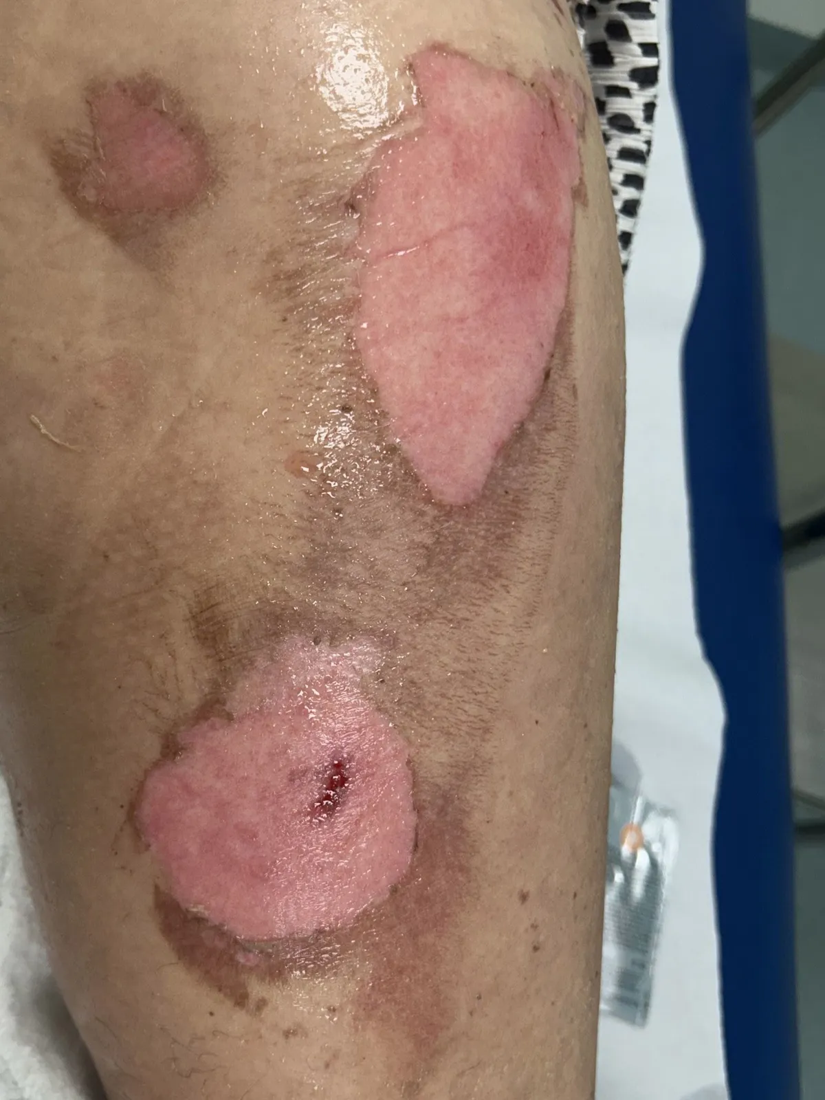 Kerrie Roberts, KerrieRoberts,
Pic from Kennedy News & Media (Pictured: THE BURNS 52-YEAR-OLD KERRIE ROBERTS' SUFFERED AFTER THE VAPE BATTERY EXPLODED IN HER POCKET.) A mum feared she'd burn to death when her vape battery exploded 'like a firework' in her pocket - setting her puffer coat and dress 'on fire'. Kerrie Roberts, from Harlow in Essex, was sitting in her friend's car when she claims her rechargeable vape blew up in her coat pocket without warning on October 19th. At first, the pair believed the stationary vehicle was malfunctioning and the whole car was going to set alight. DISCLAIMER: While Kennedy News and Media uses its best endeavours to establish the copyright and authenticity of all pictures supplied, it accepts no liability for any damage, loss or legal action caused by the use of images supplied and the publication of images is solely at your discretion. SEE KENNEDY NEWS COPY - 0161 697 4266
