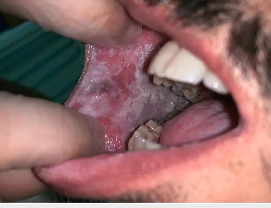 Akár napi egy ital is növelheti a szájrák kockázatát. Jobboldali szájüregi nyálkahártya, melyet szabálytalan, jól definiált szegélyű fehér plakk borít.