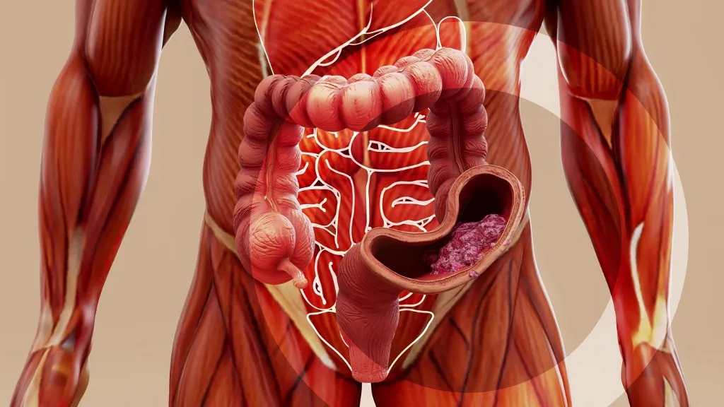 A vastagbélrák gyakran tünetmentesen alakul ki — a rendszeres szűrés és a polipok időbeni eltávolítása életet menthet.