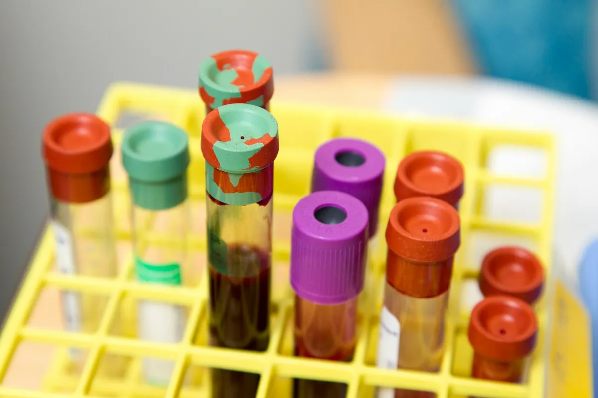 Az eredmények szerint a toxikus a fehérjék akár 20 évvel a klinikai tünetek előtt kimutathatók a vérből