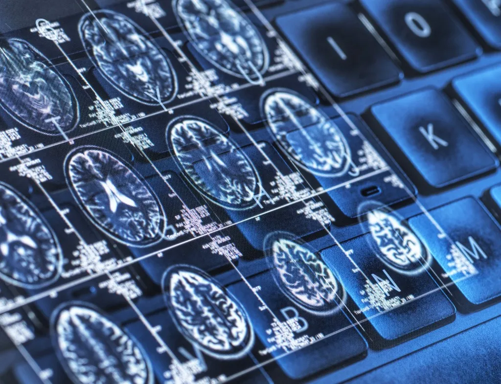 Az Alzheimer-kór is részben ugyanazokhoz a genetikai változásokhoz köthető, mint egyes daganatos betegségek