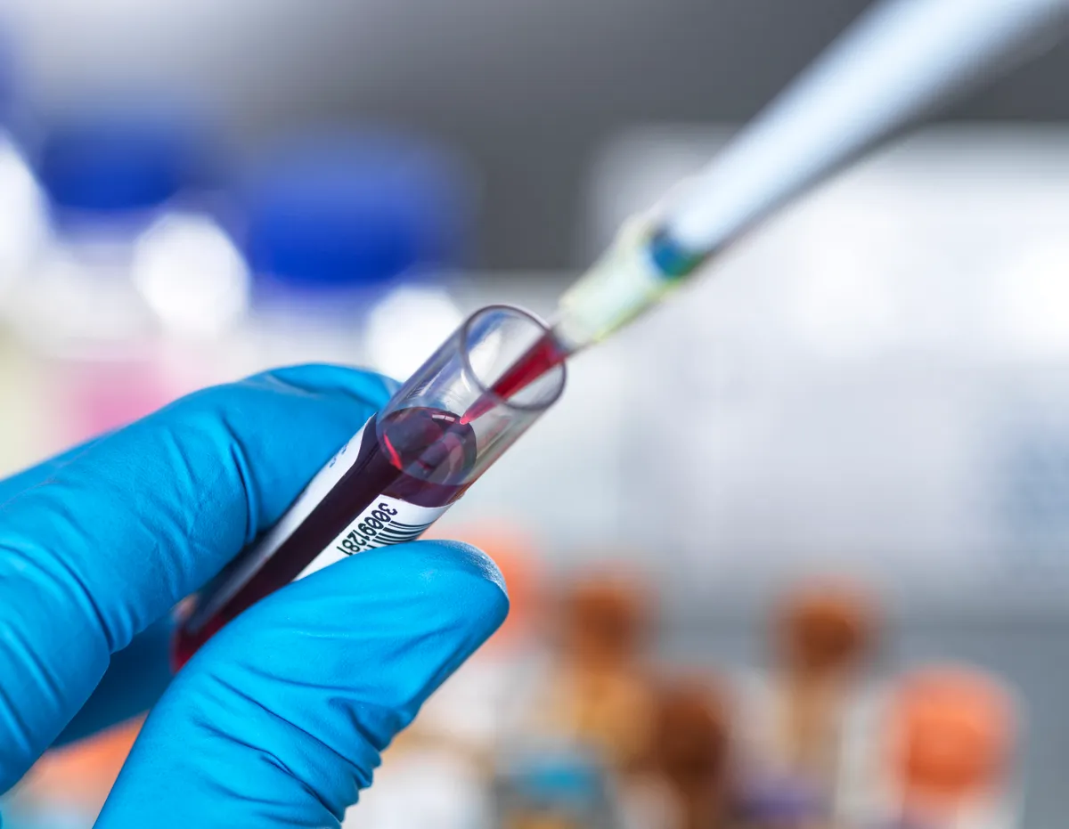 Az OncoRay kutatócsoportja által felfedezett biomarker segítségével a prosztatarák agresszív formái sokkal korábban és pontosabban felismerhetővé válhatnak.