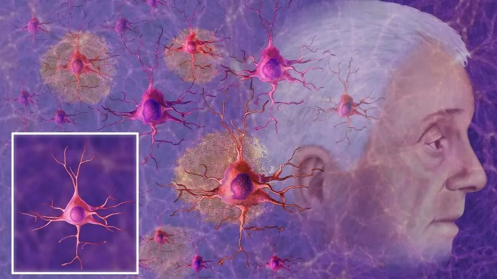 Alzheimer-kór Neurons in Alzheimer's disease, illustration. In Alzheimer's disease, neurons undergo progressive degeneration due to the accumulation of beta-amyloid plaques and tau protein tangles. This disrupts synapses, interrupts neuronal communication and leads to cell death, causing memory loss, cognitive decline and difficulties with brain function. (Photo by ILUSMEDICAL/SCIENCE PHOTO LIBRAR / AAR / Science Photo Library via AFP)