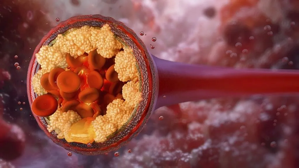 koleszterin Cross-section illustration of a blood vessel clogged with atherosclerotic plaques composed of cholesterol deposits. Red blood cells flow through the narrowed artery, which can restrict blood circulation and increase cardiovascular risk. (Photo by RUSLANAS BARANAUSKAS/SCIENCE PHO / RBU / Science Photo Library via AFP)