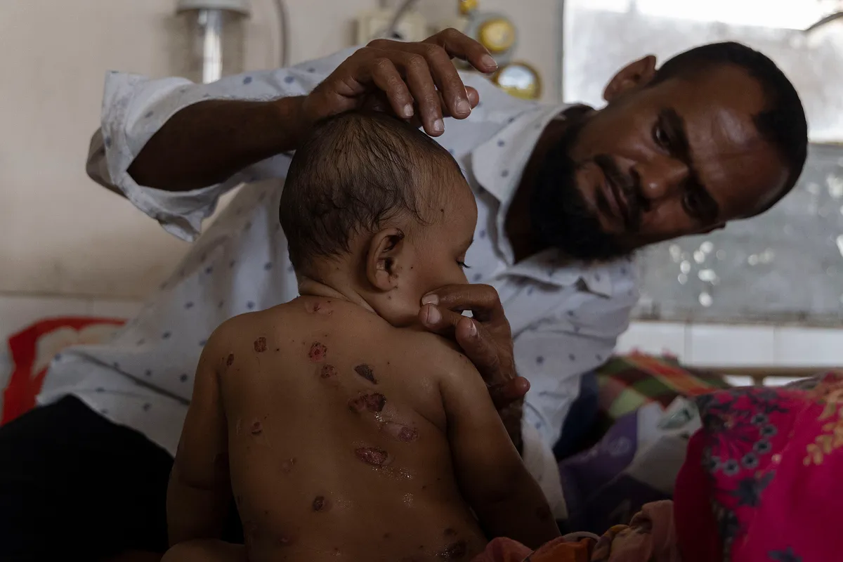 Bangladesben sürgősségi kanyaró elleni oltásokkal próbálják megfékezni a járványt. Fotó: Abdul Goni/Drik/Getty Images