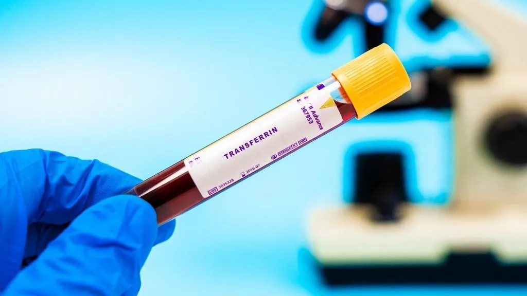 rák Transferrin blood test. Iron transport marker. Measures transferrin levels, affected in cancers with iron metabolism changes, used for monitoring treatment. (Photo by Wladimir Bulgar/Science Photo Li / WBU / Science Photo Library via AFP)