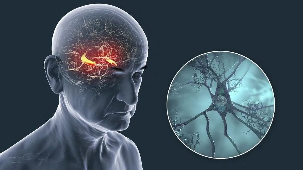 Alzheimer-kór Illustration of Alzheimer's disease, showing hippocampus degeneration and a close-up of damaged neurons with plaques and tangles. (Photo by KATERYNA KON/SCIENCE PHOTO LIBRA / KKO / Science Photo Library via AFP)