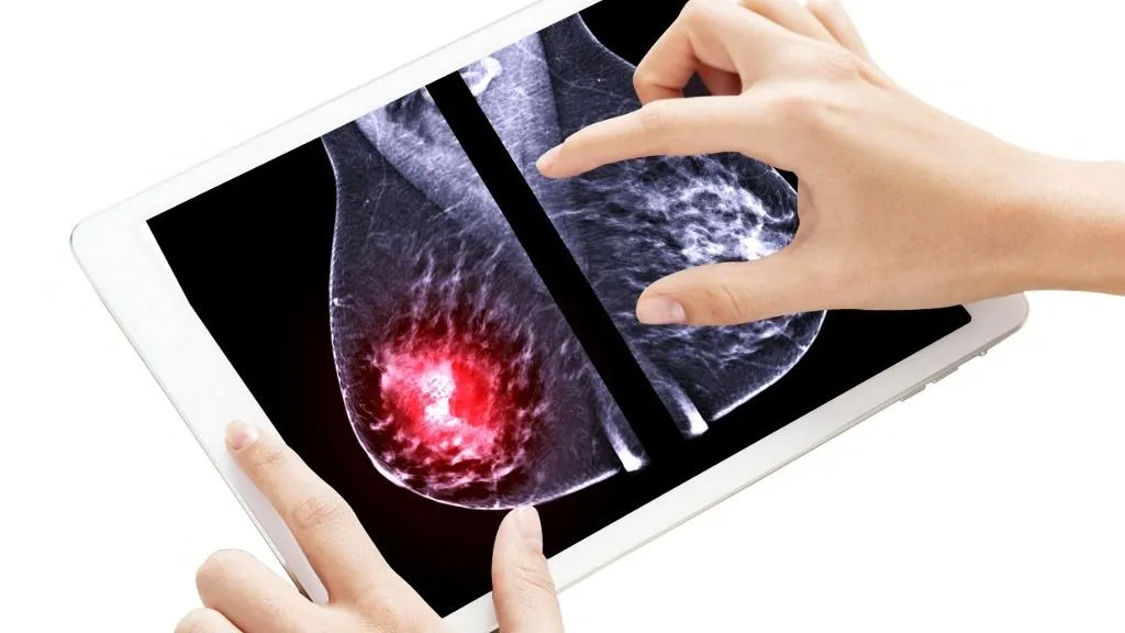 mellrák Conceptual image of a mammogram on a tablet, showing a tumour in the mediolateral oblique (right) view. (Photo by SAMUNELLA/SCIENCE PHOTO LIBRARY / SPD / Science Photo Library via AFP)