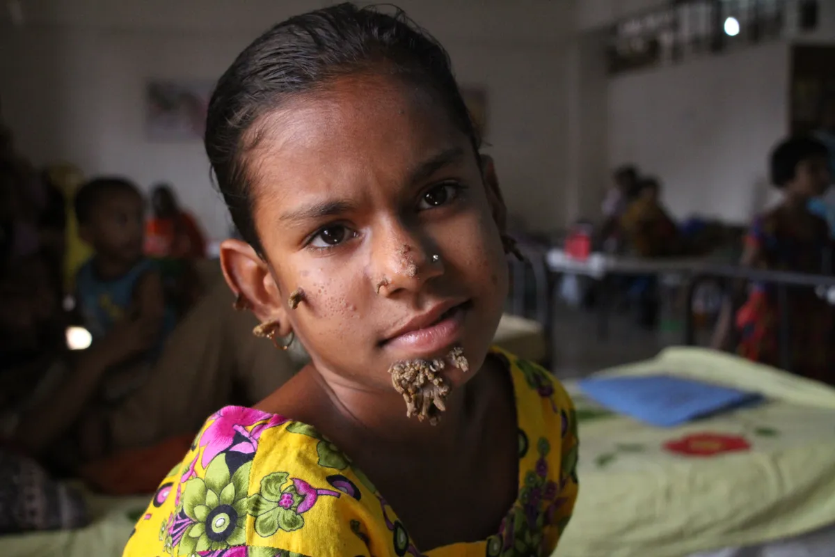 A faember-szindróma betegségben szenvedő bangladesi kislány, Szahana Khatun