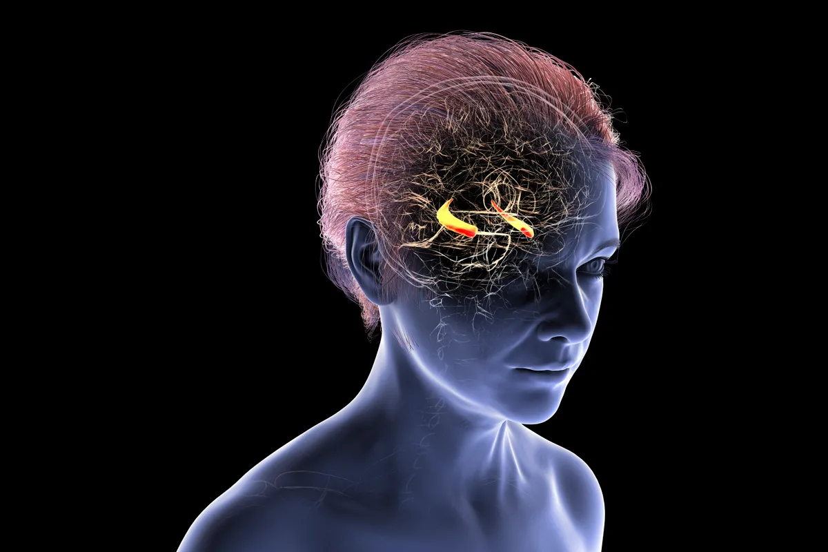agy, nő, Alzheimer-kór