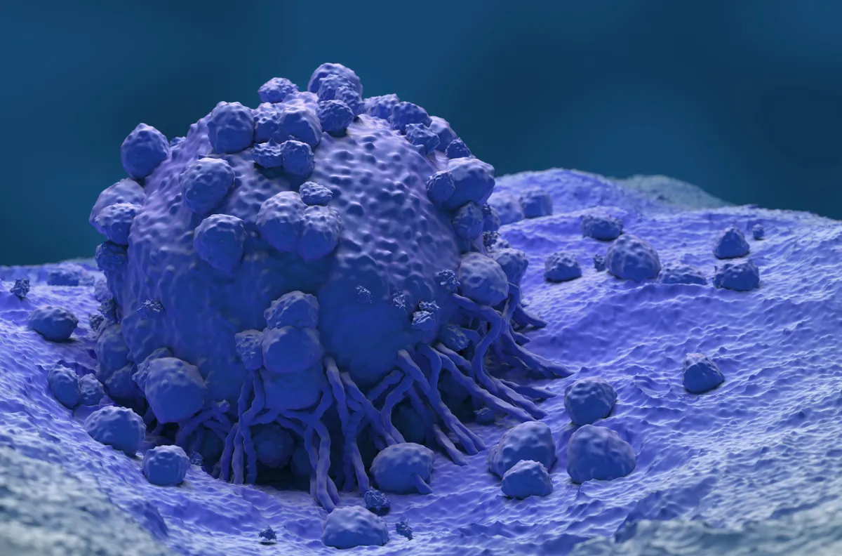 Melanoma cell, illustration. Melanoma is a form of skin cancer that arises from melanocytes, the cells that produce melanin, the pigment that gives skin its colour. (Photo by NEMES LASZLO/SCIENCE PHOTO LIBRA / NLA / Science Photo Library via AFP)