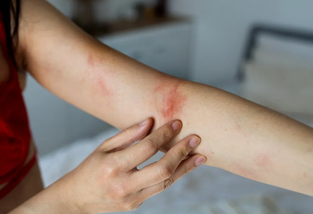 fiatal nő ekcémás karral - házi praktikák ekcémára