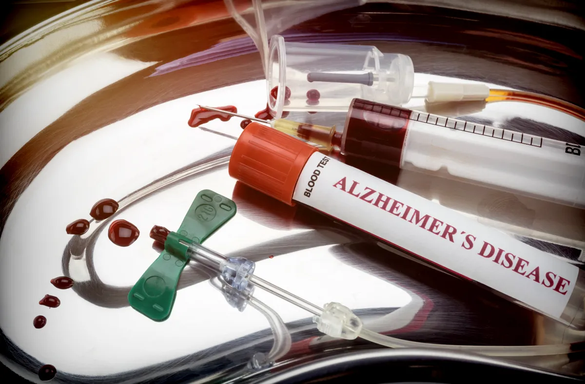 Alzheimer-kór vérvizsgálatát jelképező vérminta, fecskendő és vérvételi eszközök egy fémtálcán