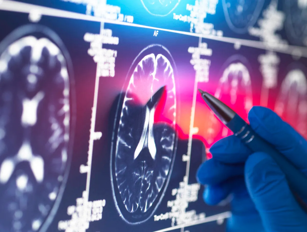 agyi MRI-felvétel, demencia, béta-amiloid, agyi elváltozások, neurológiai vizsgálat, Alzheimer-kór