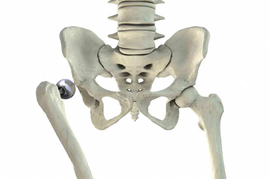 csípőimplantátum, ízületi protézis, mesterséges ízület, fémrészecskék, kobalt, titán, agy, Alzheimer-kór, demencia, vér-agy gát A csípőprotézis részecskéi az agyba is eljuthatnak egy új kutatás szerint Posterior dislocation of unipolar hip hemiarthroplasty, illustration. Showing the posterior displacement of the prosthetic femoral head from its native acetabulum, isolated medical depiction. (Photo by KATERYNA KON/SCIENCE PHOTO LIBRA / KKO / Science Photo Library via AFP)